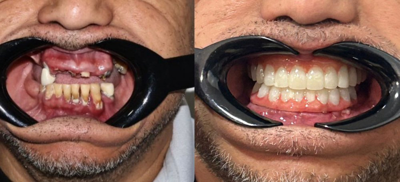 Slider image (5) Proesthetic Dental Care in Los Algodones, Mexico